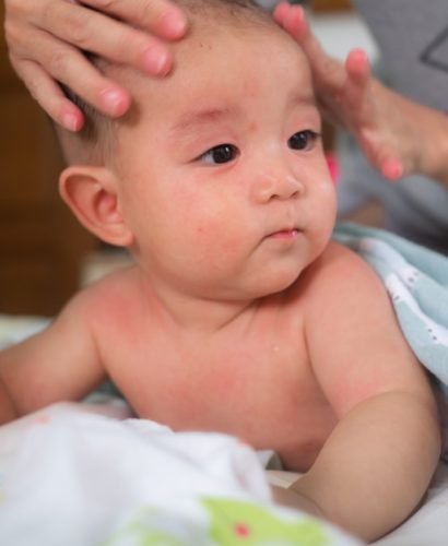 baby-has-an-allergic-reaction-to-the-face-and-body-and-mother-put-the-baby-lotion-on-his-head_t20_mLXQYj